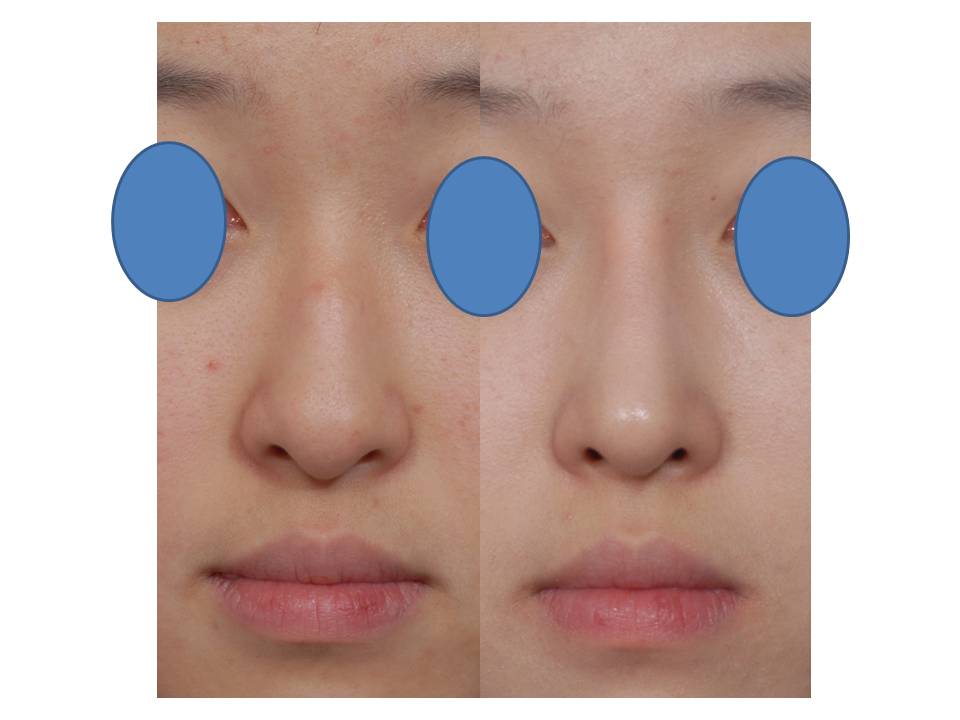 驼峰鼻整形有哪些类型